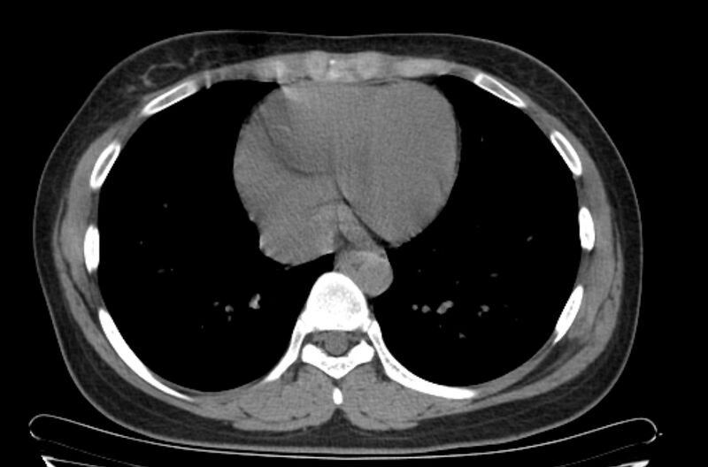 File:Cannonball metastases - uterine choriocarcinoma (Radiopaedia 70137-80173 Axial non-contrast 86).jpg