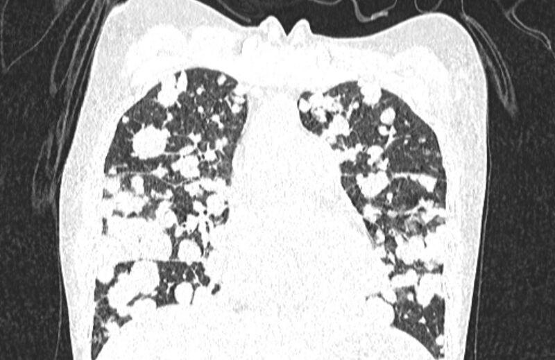 File:Cannonball metastases from breast cancer (Radiopaedia 91024-108569 Coronal lung window 55).jpg