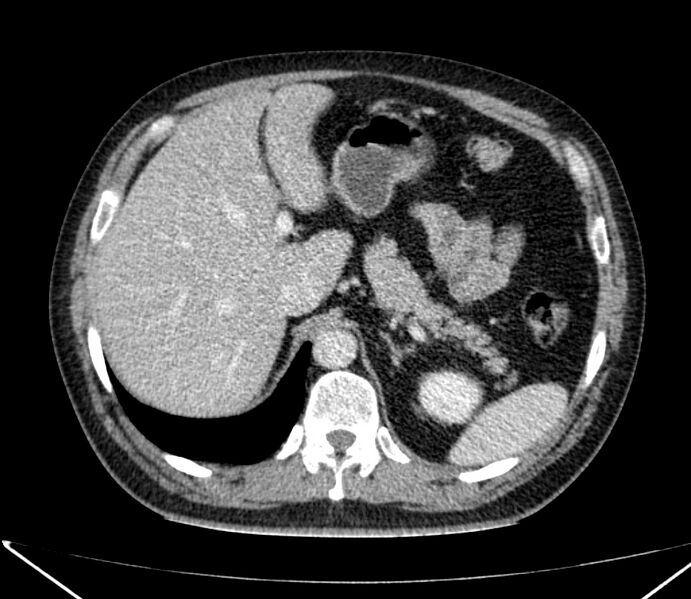 File:Carcinoid tumor with hepatic metastases (Radiopaedia 22651-22670 C 36).jpg