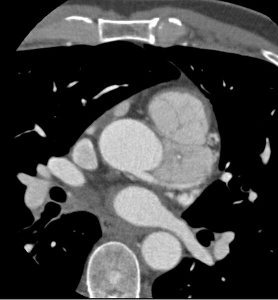 File:Cardiac hemangioma (Radiopaedia 16971-16679 A 18).JPG