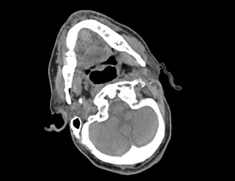 File:Carotid artery pseudoaneurysm (Radiopaedia 84030-99259 Axial non-contrast 1).jpg