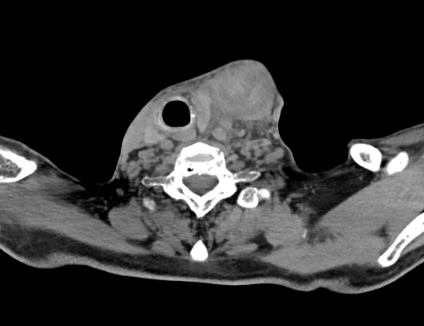Carotid artery pseudoaneurysm (Radiopaedia 84030-99259 Axial non-contrast 42).jpg