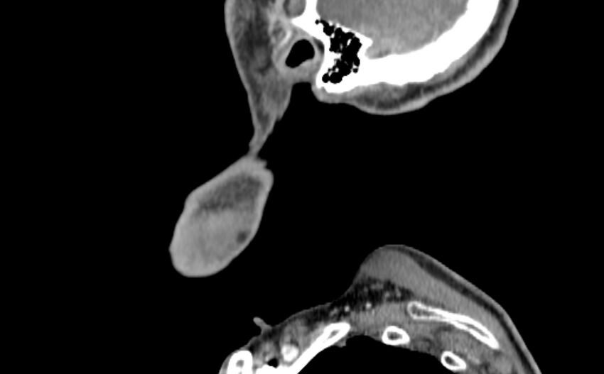Carotid artery pseudoaneurysm (Radiopaedia 84030-99259 E 65).jpg