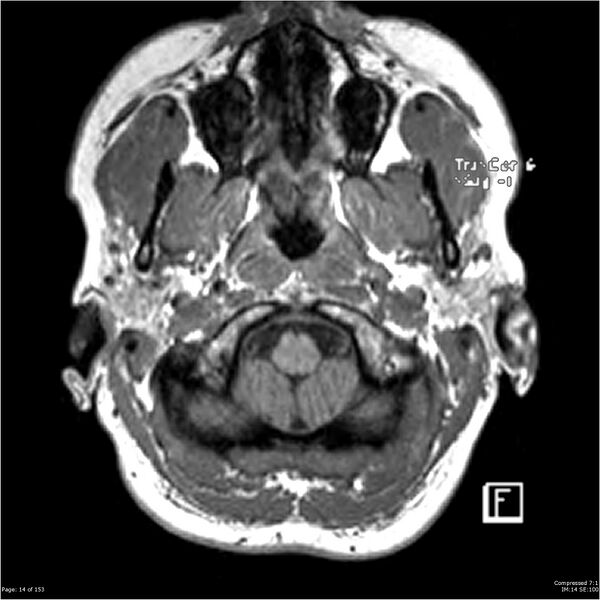 File:Cavernous malformation (cavernous angioma or cavernoma) (Radiopaedia 36675-38237 Axial T1 3).jpg
