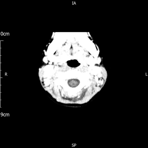 File:Cavernous sinus thrombosis (Radiopaedia 79414-92510 Axial Brain 19).jpg