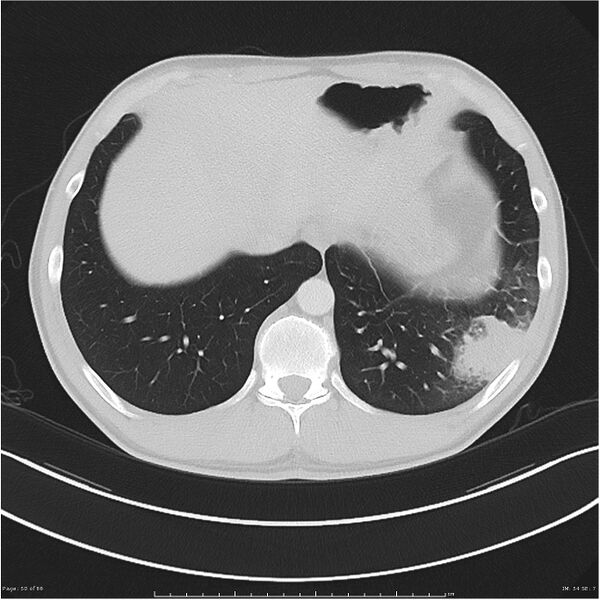 File:Cavitating lung cancer (Radiopaedia 25796-25945 Axial lung window 50).jpg