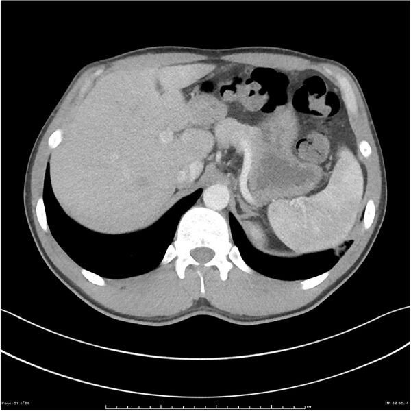 File:Cavitating lung cancer (Radiopaedia 25796-25945 C+ arterial phase 59).jpg