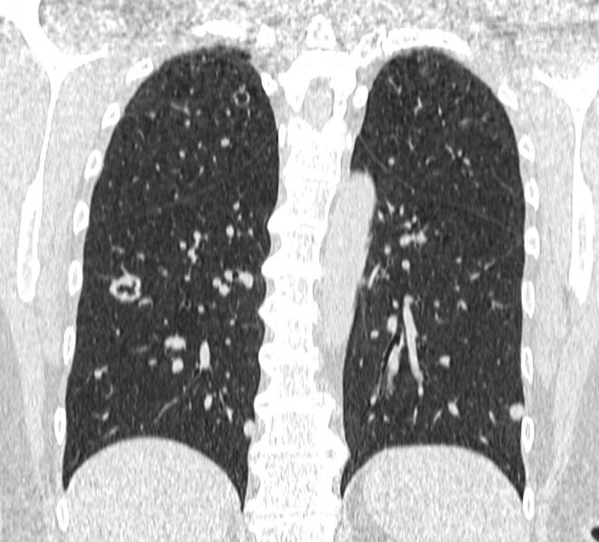 File:Cavitating pulmonary metastases (Radiopaedia 17796-17555 Coronal lung window 20).jpg