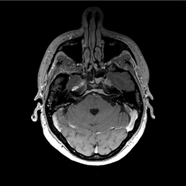 File:Central base of skull meningioma (Radiopaedia 53531-59549 Axial T1 C+ 6).jpg