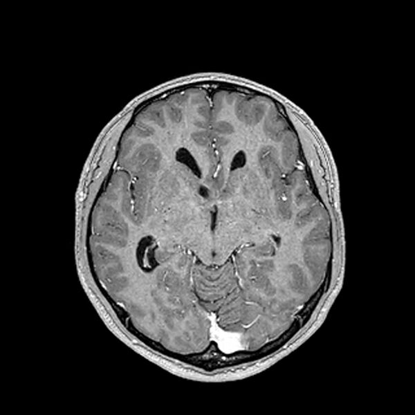 File:Central neurocytoma (Radiopaedia 79320-92380 Axial T1 C+ 113).jpg