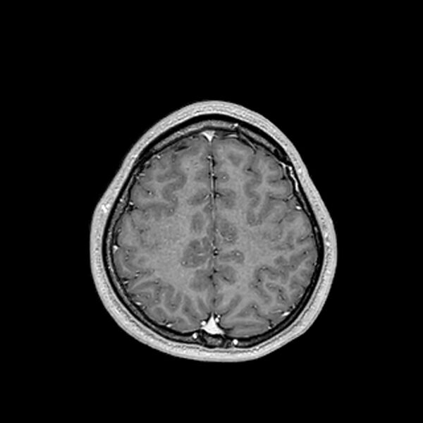 File:Central neurocytoma (Radiopaedia 79320-92380 Axial T1 C+ 186).jpg