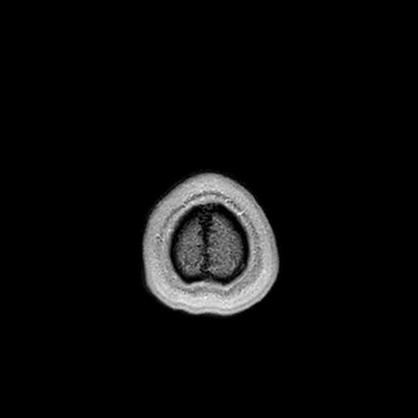 File:Central neurocytoma (Radiopaedia 79320-92380 Axial T1 C+ 229).jpg