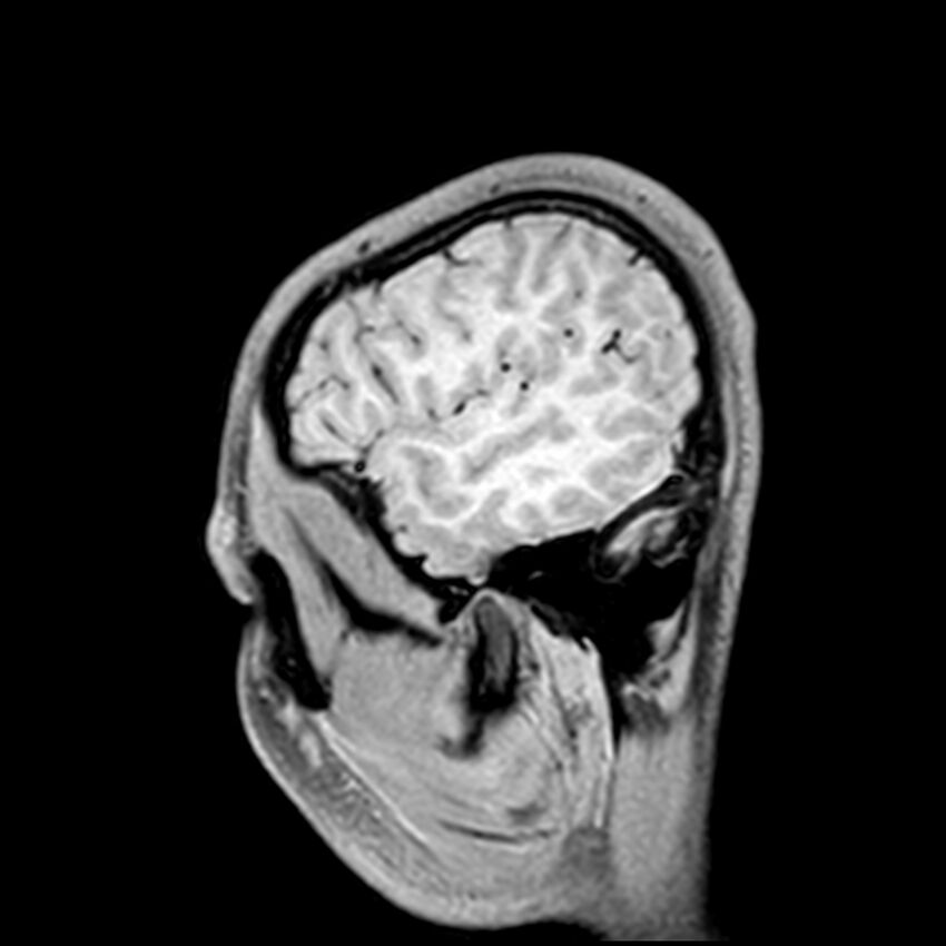 Central neurocytoma (Radiopaedia 79320-92380 Sagittal T1 46).jpg