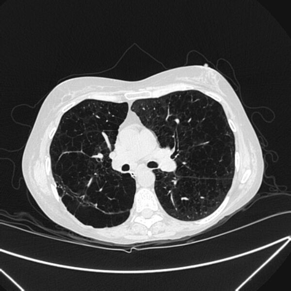 File:Centrilobular pulmonary emphysema (Radiopaedia 24495-24789 Axial lung window 45).jpg
