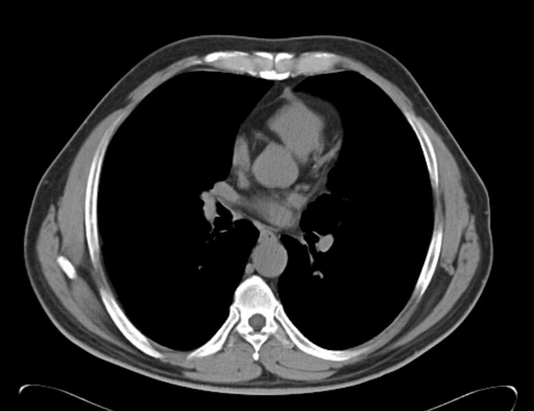 File:Centrilobular pulmonary emphysema (Radiopaedia 26808-26971 Axial non-contrast 24).jpg