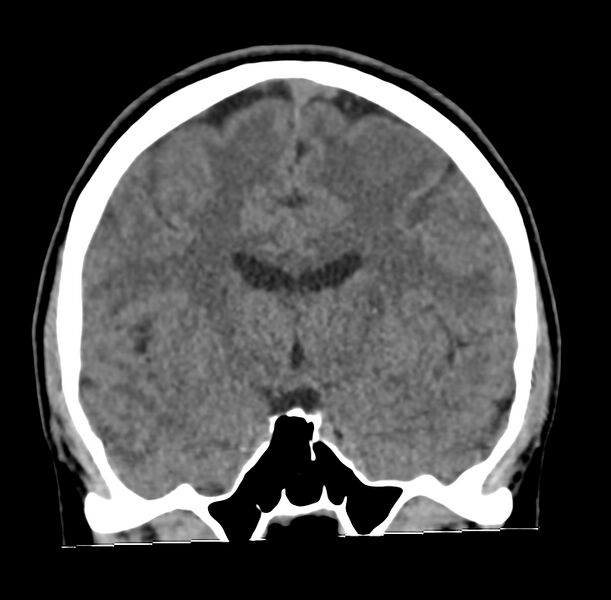 File:Cerebellar agenesis (Radiopaedia 30203-30817 Coronal non-contrast 17).jpg