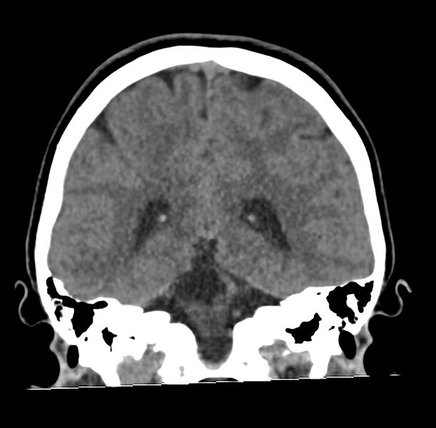 File:Cerebellar agenesis (Radiopaedia 30203-30817 Coronal non-contrast 28).jpg