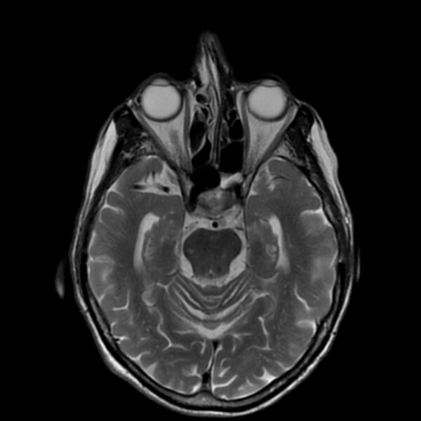 File:Cerebellar ataxia with neuropathy and vestibular areflexia syndrome (CANVAS) (Radiopaedia 74283-85159 Axial T2 9).jpg