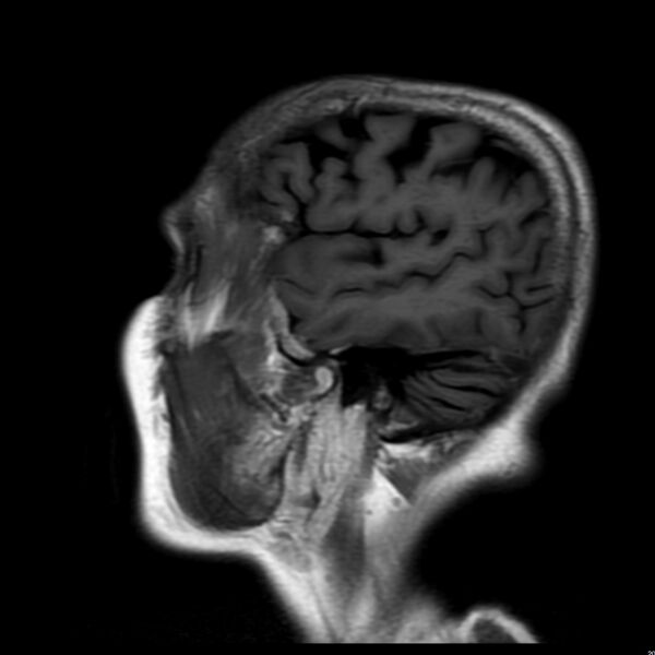 File:Cerebellar ataxia with neuropathy and vestibular areflexia syndrome (CANVAS) (Radiopaedia 74283-85159 Sagittal FLAIR 4).jpg