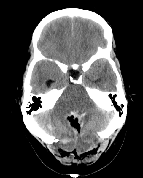 File:Cerebellar ependymoma complicated by post-operative subdural hematoma (Radiopaedia 83322-97737 Axial non-contrast 22).png