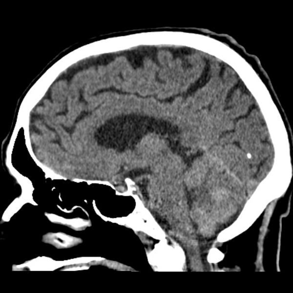 File:Cerebellar hemorrhage (Radiopaedia 27193-27359 C 21).jpg