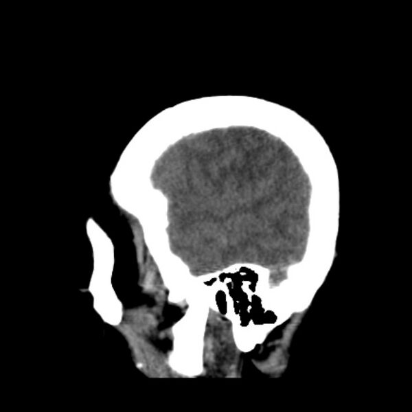 File:Cerebellar hemorrhage causing obstructive hydrocephalus (Radiopaedia 33989-35207 B 9).jpg