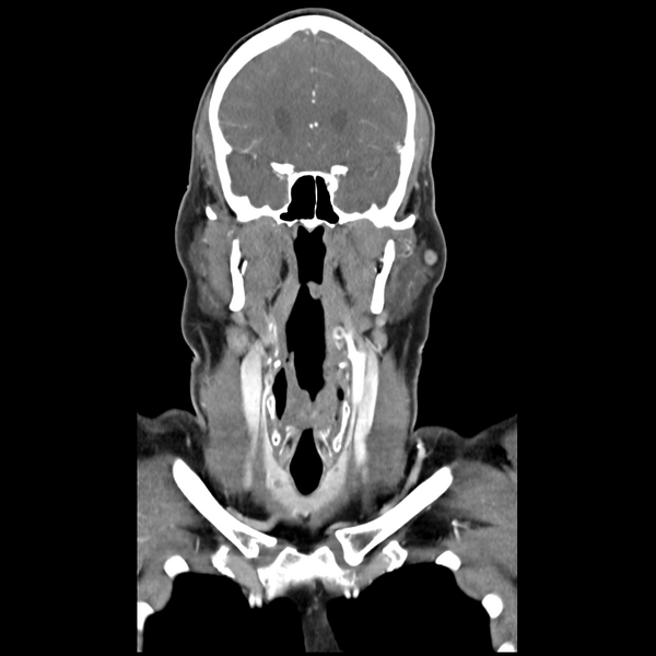File:Cerebellar infarct due to vertebral artery dissection with posterior fossa decompression (Radiopaedia 82779-97029 D 23).png
