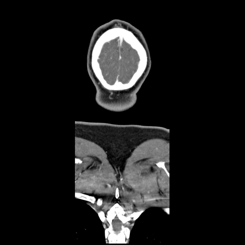 Cerebellar infarct due to vertebral artery dissection with posterior fossa decompression (Radiopaedia 82779-97029 D 63).png