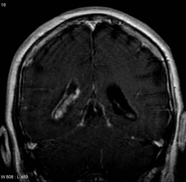 File:Cerebral abscess and ventriculitis (Radiopaedia 5024-6885 Coronal T1 C+ 8).jpg