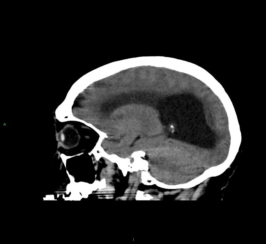 Cerebral amyloid angiopathy-associated lobar intracerebral hemorrhage (Radiopaedia 58560-65723 C 35).jpg