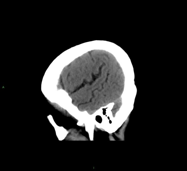 File:Cerebral amyloid angiopathy-associated lobar intracerebral hemorrhage (Radiopaedia 58561-65724 C 8).jpg
