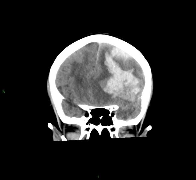 File:Cerebral amyloid angiopathy-associated lobar intracerebral hemorrhage (Radiopaedia 58561-65724 Coronal non-contrast 42).jpg