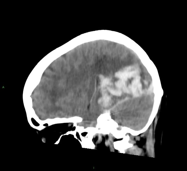 File:Cerebral amyloid angiopathy-associated lobar intracerebral hemorrhage (Radiopaedia 58754-65975 C 32).jpg