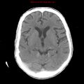 Cerebral and orbital tuberculomas (Radiopaedia 13308-13310 B 14).jpg