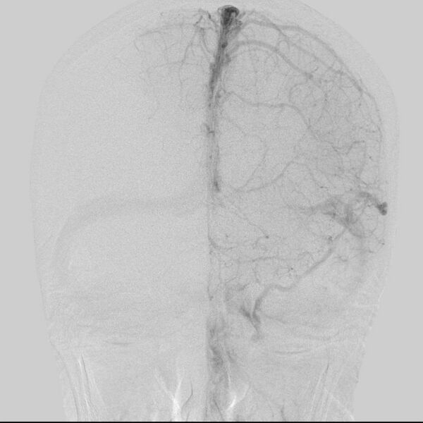 File:Cerebral aneurysm with rupture (Radiopaedia 29933-30458 LT CCA IC 21).jpg