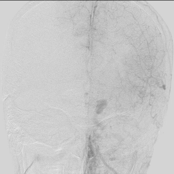 File:Cerebral aneurysm with rupture (Radiopaedia 29933-30458 LT ICA IC 20).jpg