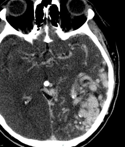 File:Cerebral arteriovenous malformation (Radiopaedia 40528-43125 B 1).jpg