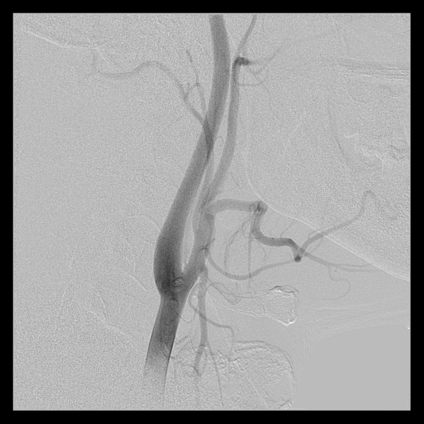 File:Cerebral arteriovenous malformation (Spetzler-Martin grade 2) (Radiopaedia 41262-44097 B 11).png
