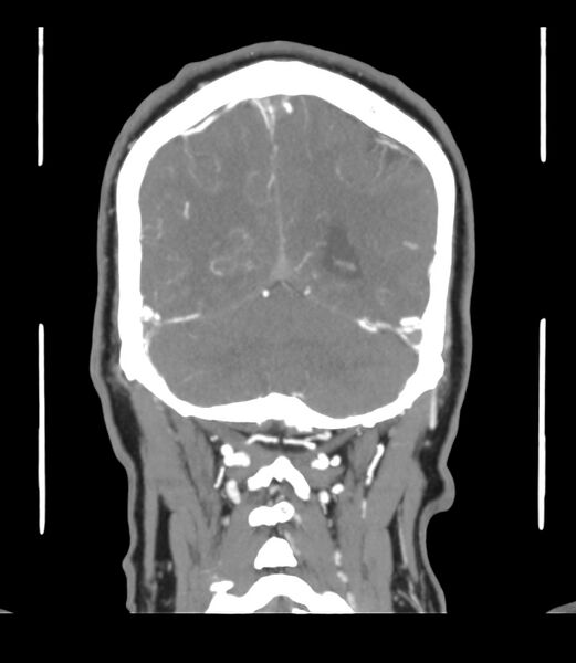 File:Cerebral dural venous sinus thrombosis (Radiopaedia 86514-102576 B 58).jpg
