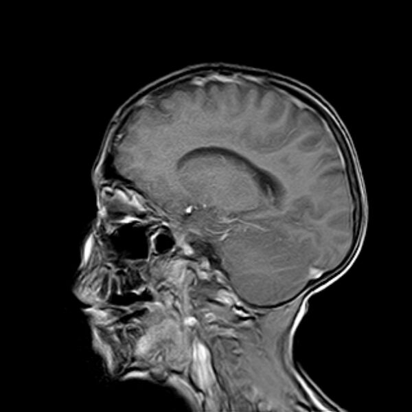 File:Cerebral tuberculoma (Radiopaedia 41152-43932 Sagittal T1 C+ 7).jpg