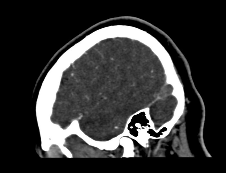 File:Cerebral venous sinus thrombosis (Radiopaedia 59224-66646 Sagittal C+ delayed 58).jpg