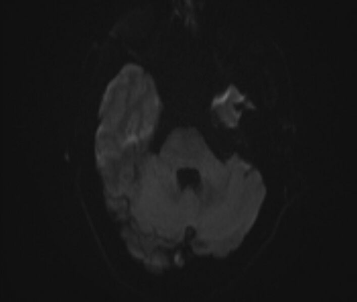 File:Cerebral venous thrombosis (Radiopaedia 71207-81504 Axial DWI 5).jpg