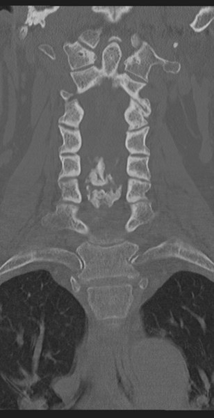 File:Cervical canal stenosis due to ossification of the posterior longitudinal ligament (Radiopaedia 47260-51823 Coronal bone window 25).png