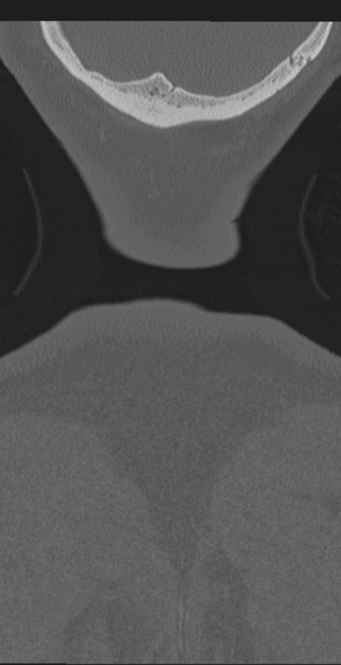 File:Cervical canal stenosis due to ossification of the posterior longitudinal ligament (Radiopaedia 47260-51823 Coronal bone window 80).png