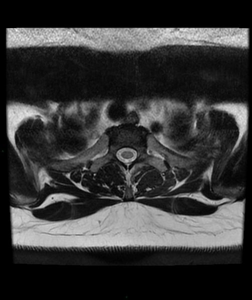 File:Cervical disc prolapse (Radiopaedia 80258-93598 Axial T2 95).jpg