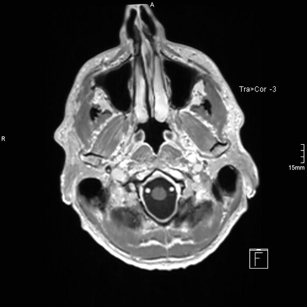 File:Cervical dural CSF leak on MRI and CT treated by blood patch (Radiopaedia 49748-54995 Axial T1 C+ 14).jpg