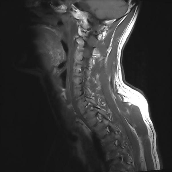File:Cervical dural CSF leak on MRI and CT treated by blood patch (Radiopaedia 49748-54995 Sagittal T1 1).png