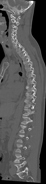 File:Cervical dural CSF leak on MRI and CT treated by blood patch (Radiopaedia 49748-54996 A 1).png
