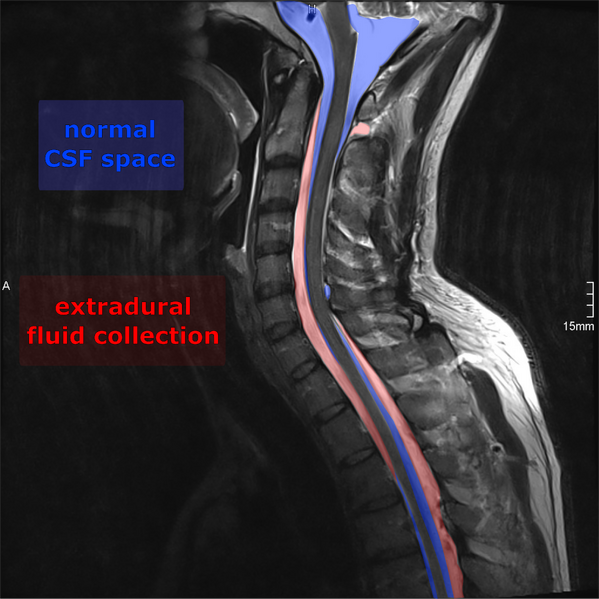 File:Cervical dural CSF leak on MRI and CT treated by blood patch (Radiopaedia 49748-54998 C 1).png