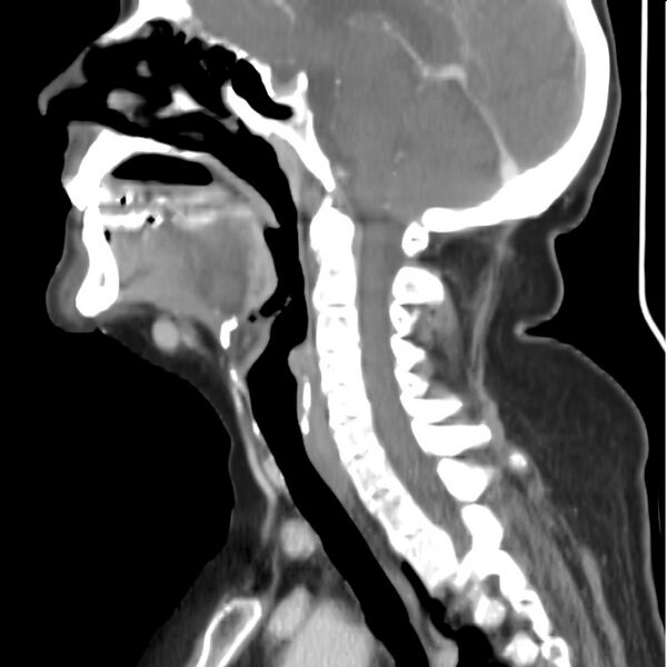 File:Cervical lymphadenopathy- cause unknown (Radiopaedia 22420-22457 D 20).jpg